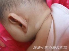 婴幼儿患上白癜风会有哪些病因导致