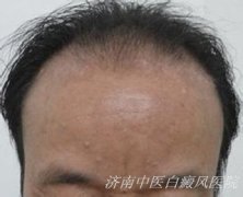 男性白斑发病是有什么原因呢