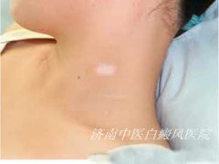 女性白癜风发病要怎么治疗