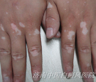 白癜风发病后患者要注意什么