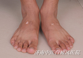 怎么治好颈部白癜风疾病