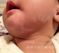 幼儿怎么还患上白癜风