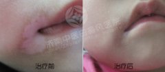 各阶段白癜风病症是什么样子