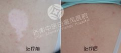 白癜风患者可以食用海产品吗