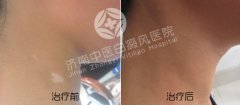 白癜风患者夏季要注意什么事项呢