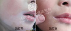 白癜风发病带来的危害有哪些