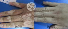 治疗白癜风多久可以见效果