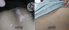 婴儿会得白癜风吗