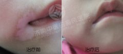 怎么治疗青少年白癜风