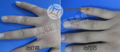 白癜风这种病怎么护理
