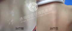 怎么正确诊断白癜风