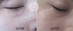 早期的白癜风有哪些注意事项