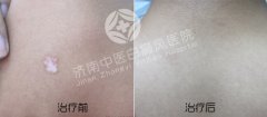 怎么正确的护理白癜风
