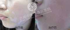 济南中医白臀风医院地址