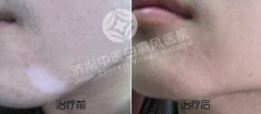 如何确定身上的白斑是白癜风