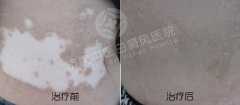 患者应该怎么护理白癜风