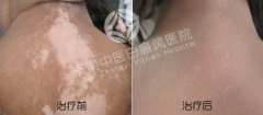 发展期白癜风多久会扩散